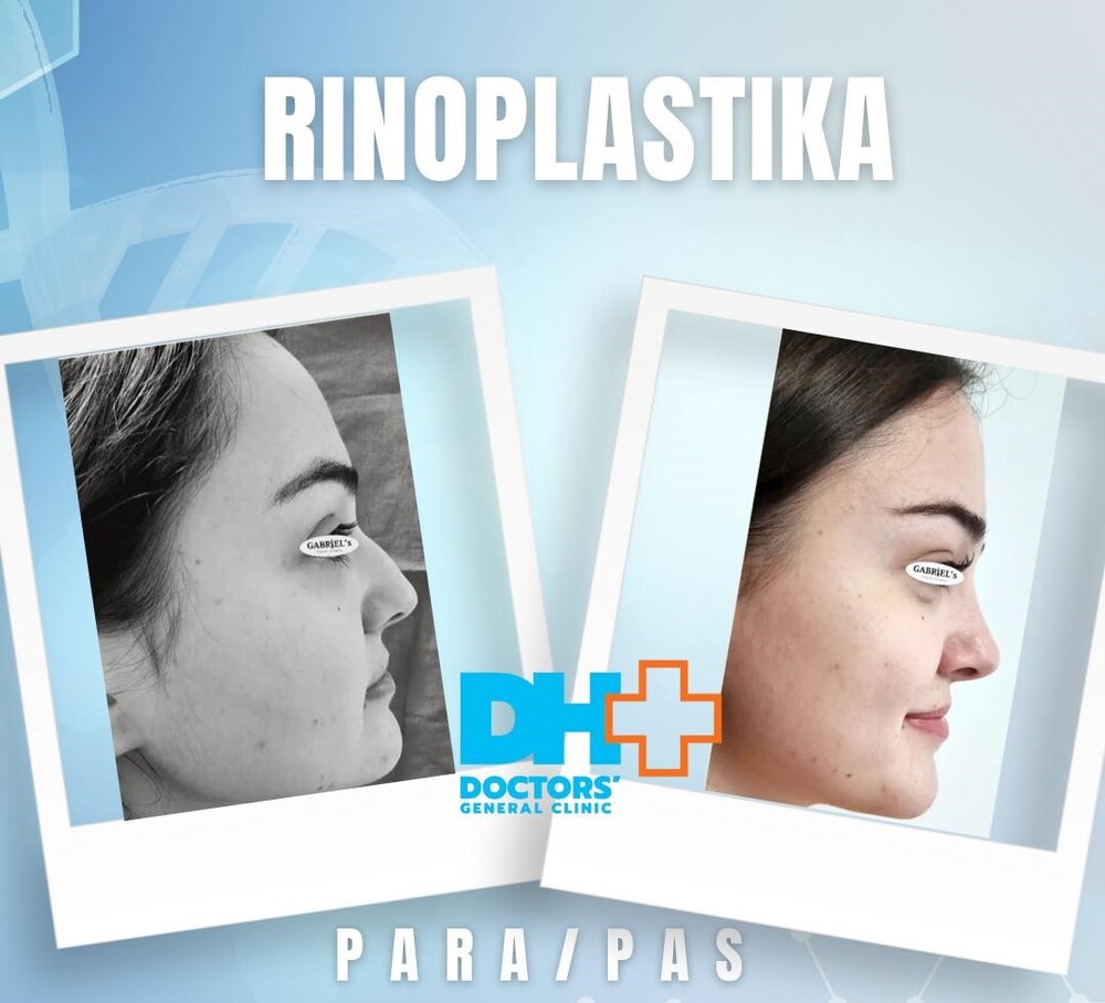 Before and After Result